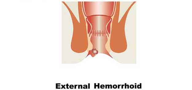 External:Jhrv0wvbge0= Hemorrhoids