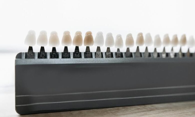 dental veneers in mississauga