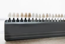 veneers guide rockville md